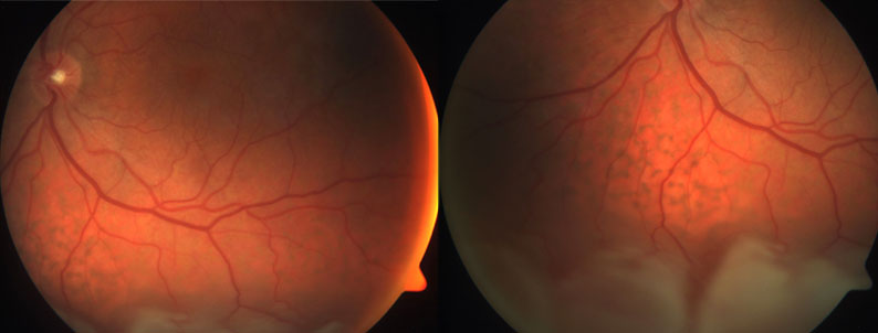 Figure 1. Left inferior retinal detachment with unusual retinal pigment epithelial changes extending into the macula.