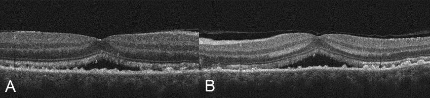 Figure 3. Right (A) and left (B) optical coherence tomography images demonstrating subfoveal fluid and subretinal deposits in both eyes.
