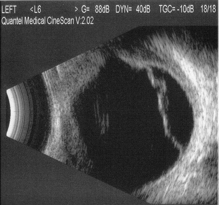 Figure 5. B-scan ultrasound showed choroidal and retinal detachment, with associated scleral thickening.