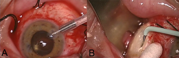 Figure 7. Anterior chamber maintainer (A) and small full thickness sclerectomy treated with diathermy (B).