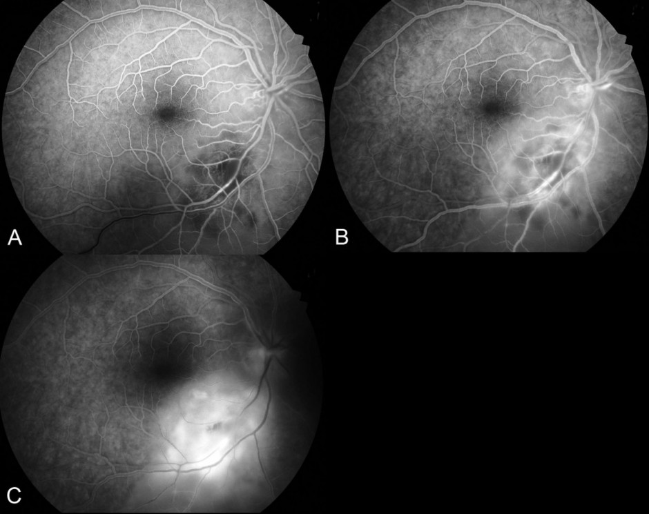 Figure 4. Fundus fluorescein angiogram: A) In the venous phase the distinct area of hypofluorescence surrounding the arteriole represents retinal ischemia. There is a delay in filling of the inferotemporal vein. B) In the mid-phase, vasculitis (hyperfluorescent vessel walls) is seen. C) In the late phase there is hyperfluorescent leakage as the dye fills the subretinal space.
