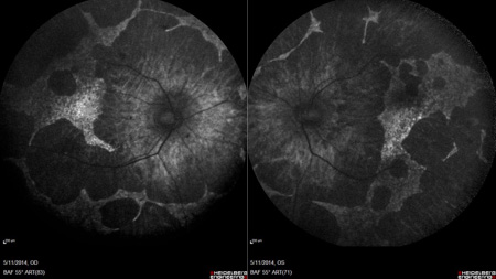 Figure 2.  Fundus autofluorescence showing marked, well defined ‘scalloped’ areas of retinal pigment epithelium loss (dark regions).