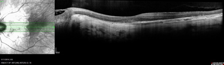 Figure 3.  OCT of the left macula showing loss of retinal pigment epithelium and underlying choroid with only a small island of residual outer retina at the fovea.