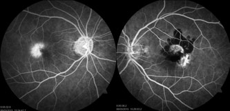 Figure 3. Fluorescein angiogram of a) right eye with late hyperfluorescence in the area of retinal telangiectasia, and b) left eye with subretinal neovascularisation superior to the macula, and an area of hyperfluorescence in the temporal macula. 