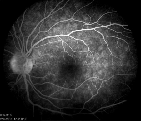 Figure 2. Fundus fluorescein angiography (FFA) showed multiple clusters of early punctate hyperfluorescence (“wreath-like” hyperfluorescence) with late staining and late leakage from the disc